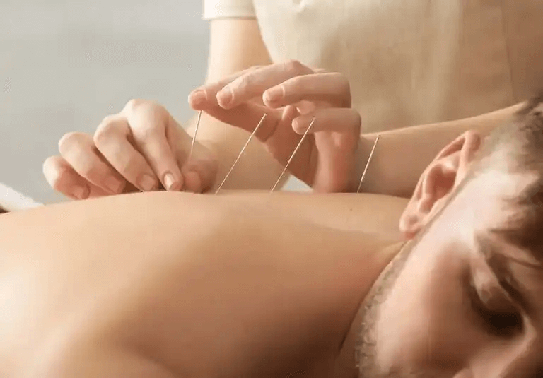 En man får akupunktur för att lindra symtom på artrit