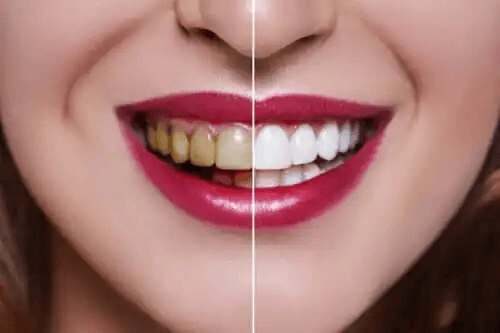 Orsakerna till missfärgade tänder
