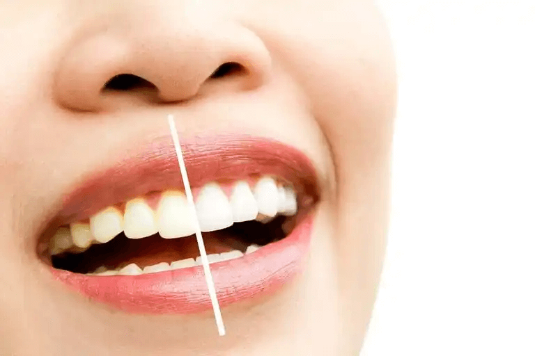 Missfärgade tänder vs vita tänder.