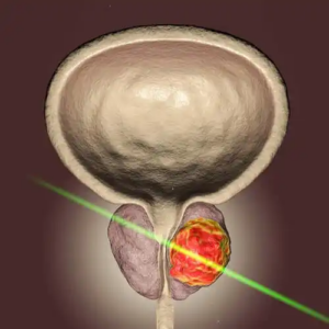Laserkirurgi av prostatan: Ett genombrott inom prostatakirurgi