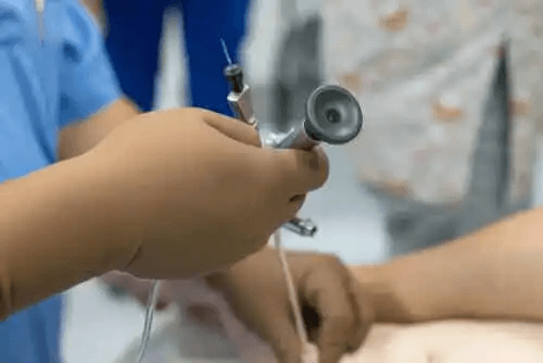 prostatalaser i läkarens händer i en operationssal