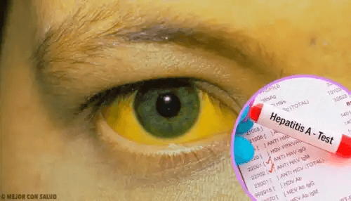 En gulfärgning av hud och ögon på grund av gulsot hep A-test