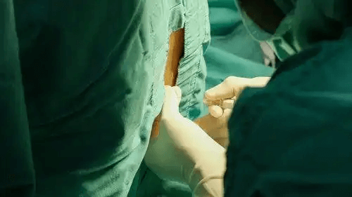 En person som får en lumbalpunktion.