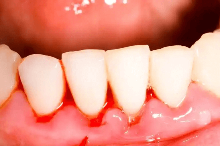Blödande tandkött på grund av stomatit