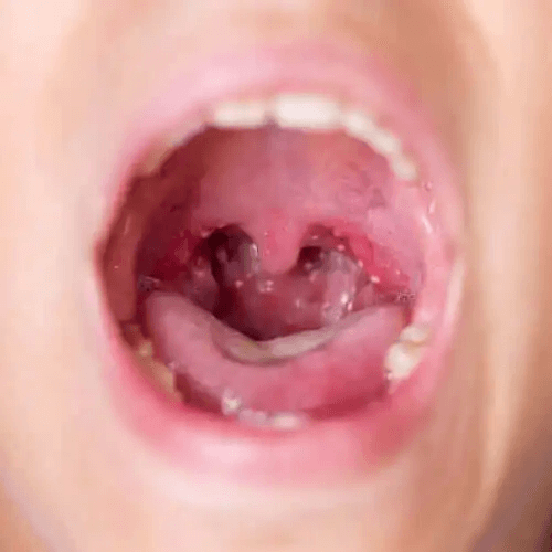 Ett barns hals med vita fläckar.