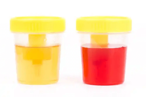 Blod i urinen ses i urinprovet
