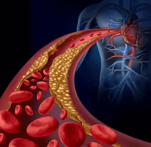 En illustration av en koagulerad artär.