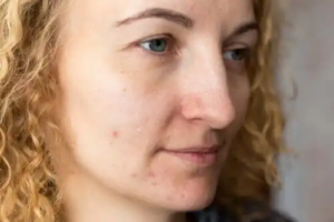 Så kan du förhindra melasma