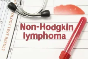 Non-Hodgkins lymfom: allt du behöver veta