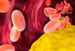 Är VLDL-kolesterol skadligt?