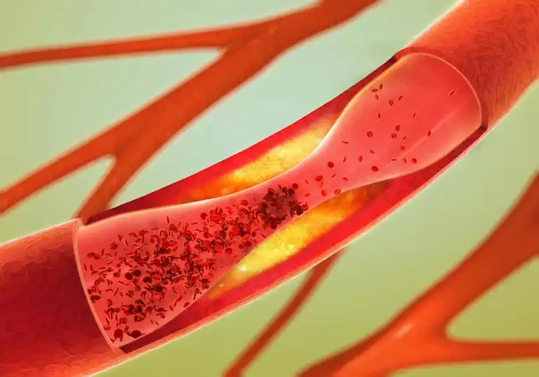 Illustration av kolesterol i blodomloppet.