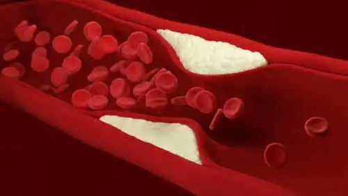 Avlagringar av kolesterol i blodet