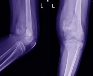Egenskaper för osteosarkom hos barn