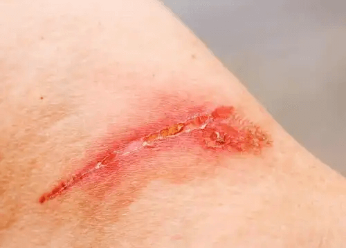 Ett sår på en persons hud.