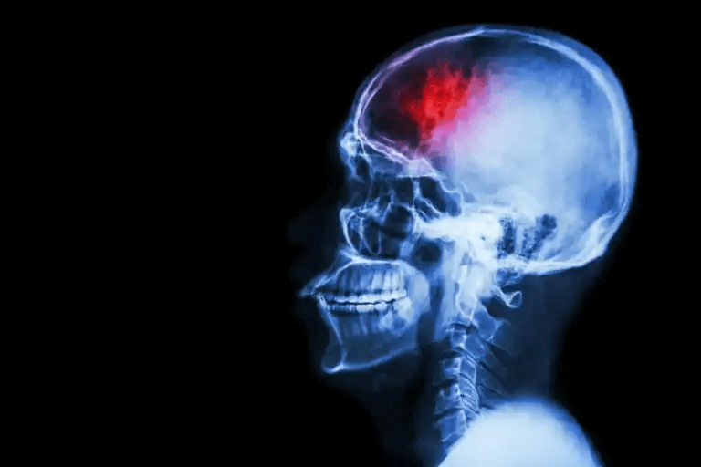 Röntgen av ett huvud