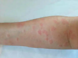 Vanliga frågor om lupus