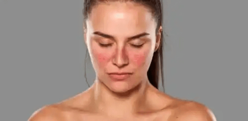 En kvinna som lider av lupus har utslag i ansiktet