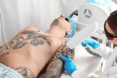Ta bort tatueringar med laser: Hur fungerar det på huden?