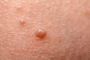 Allt om molluscum contagiosum