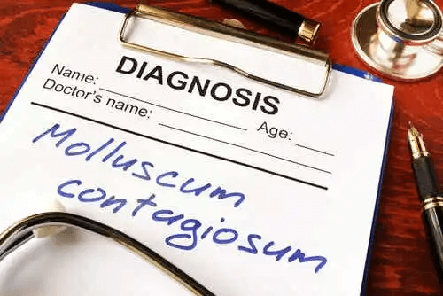 Diagnos av Molluscum contagiosum