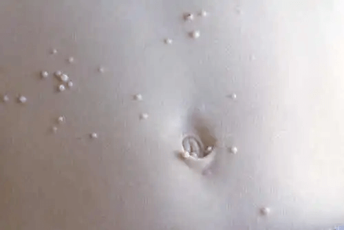 Molluscum contagiosum på magen