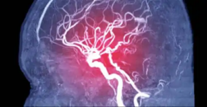 Cerebrala emboli: Orsaker, symptom och olika typer