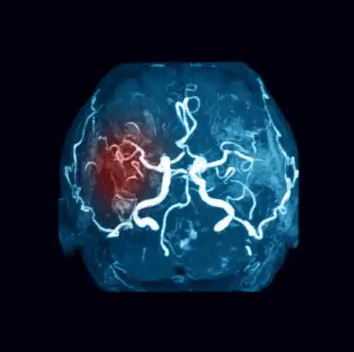 Illustration av cerebrala emboli