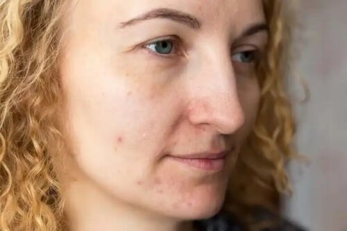 En kvinna med melasma