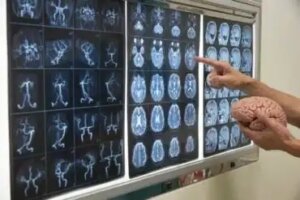 Information angående tuberös skleros