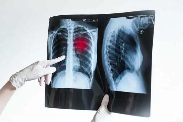Röntgenbild visar problem i lungan.