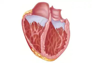 Vad du bör veta om dilaterad kardiomyopati