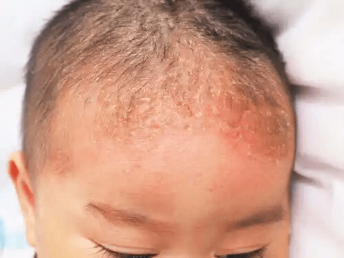 Vad är seborroisk dermatit hos spädbarn?
