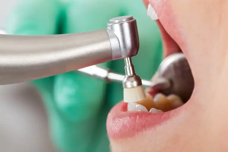Tandrengöring hos tandläkaren.