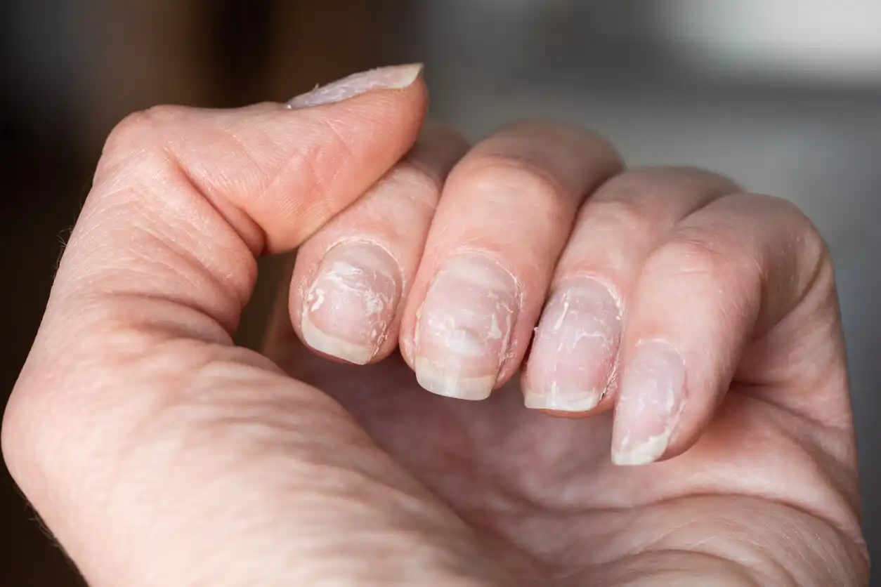 varför får man räfflade naglar