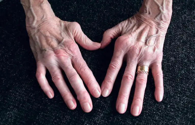 Händer med reumatoid artrit