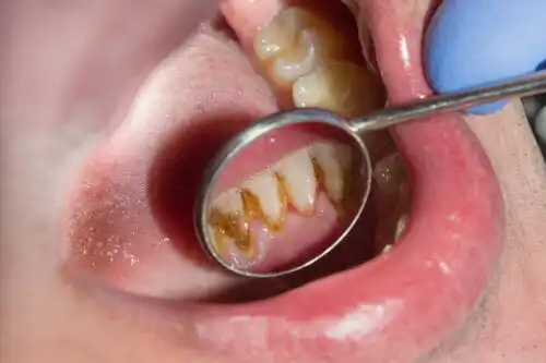 Varför blir tandsten svart? Behandling och förebyggande