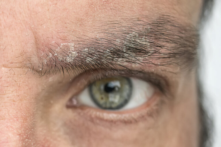 Mjäll i ögonbrynen: Varför det uppstår och hur man blir av med det
