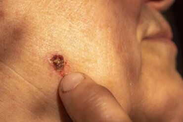 Basalcellscancer: Den vanligaste hudcancern