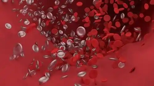 Vad innebär det att drabbas av hjärnemboli?