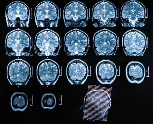 Diagnos och behandling vid en hjärnabscess