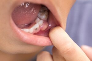 Symtom på tandinfektion som börjat spridas ut i kroppen
