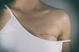 Typer av kirurgi vid behandling av bröstcancer