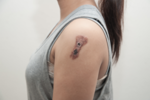 Skivepitelcancer i huden: orsaker, symtom och behandlingar