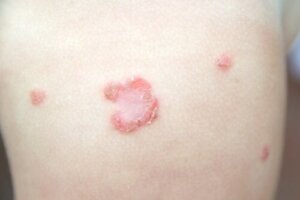 Impetigo hos barn: Smittsamt men går att behandla