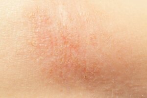 6 naturliga botemedel för torr hud
