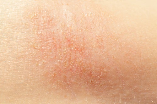 6 naturliga botemedel för torr hud