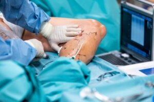 Endolaserkirurgi vid åderbråck: fler fördelar än nackdelar