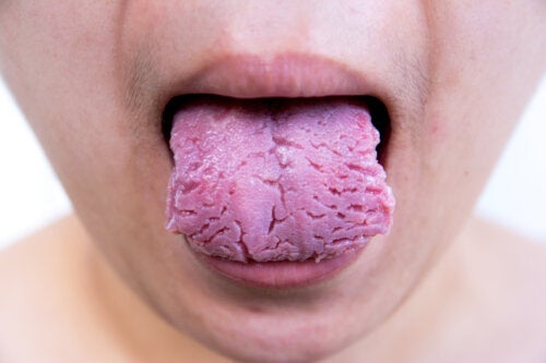 Fissurerad tunga: orsaker och behandling