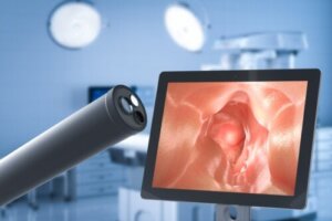 Kirurgi för att behandla gastroesofageal refluxsjukdom