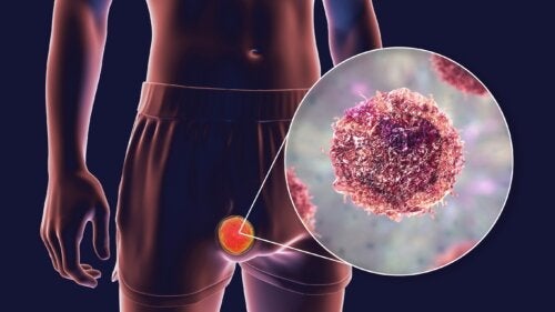 Teratom eller tvillingcystor: Typer, symtom och behandling